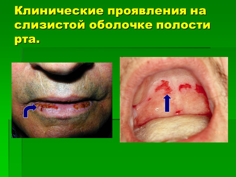 Клинические проявления на слизистой оболочке полости рта.